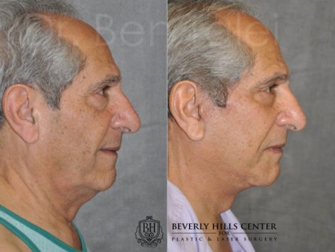 Lower Eyelid Tightening - Right Side