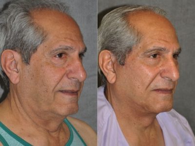 Lower Eyelid Tightening - Right Side