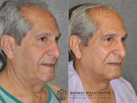 Lower Eyelid Tightening - Right Side