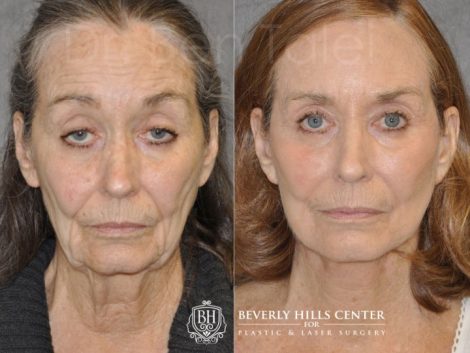 Upper Eyelid Ptosis (Drooping) Repair combined with a Painless Deep Plane SMART Lift for facial rejuvenation - Front