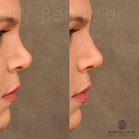 Beverly Hills Center Female Patient Before and After Non-surgical Rhinoplasty Procedure