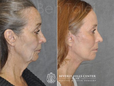 Upper Eyelid Ptosis (Drooping) Repair combined with a Painless Deep Plane SMART Lift for facial rejuvenation - Right Side