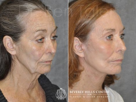 Upper Eyelid Ptosis (Drooping) Repair combined with a Painless Deep Plane SMART Lift for facial rejuvenation - Right Side