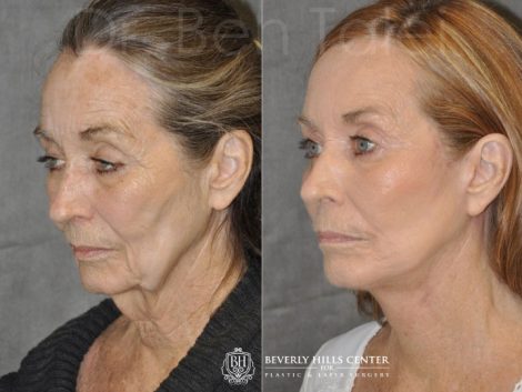 Upper Eyelid Ptosis (Drooping) Repair combined with a Painless Deep Plane SMART Lift for facial rejuvenation - Left Side