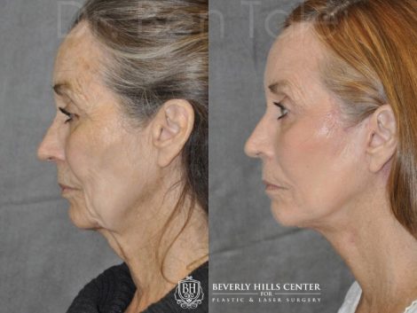 Upper Eyelid Ptosis (Drooping) Repair combined with a Painless Deep Plane SMART Lift for facial rejuvenation - Left Side