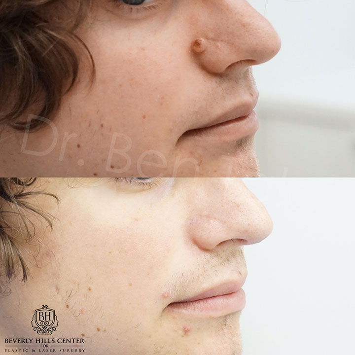 Scar Piercing Mole Removal Before Afters Beverly Hills Center