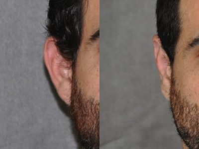 Otoplasty (Ear Pinning and Reshaping)