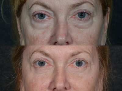 Lower Eyelid Rejuvenation - Front