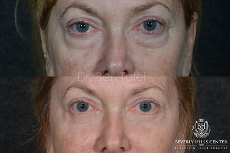 Lower Eyelid Rejuvenation - Front