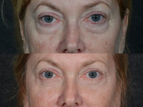 Lower Eyelid Rejuvenation - Front