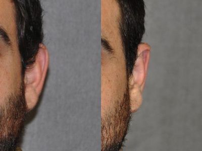 Otoplasty (Ear Pinning and Reshaping)