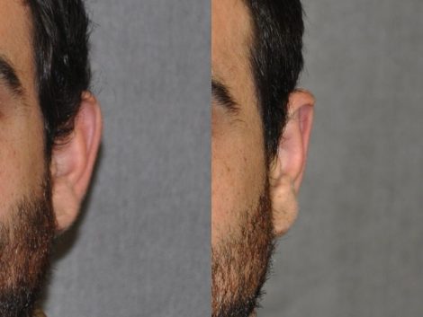 Otoplasty (Ear Pinning and Reshaping)