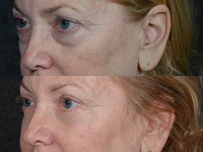 Lower Eyelid Rejuvenation - Left Side