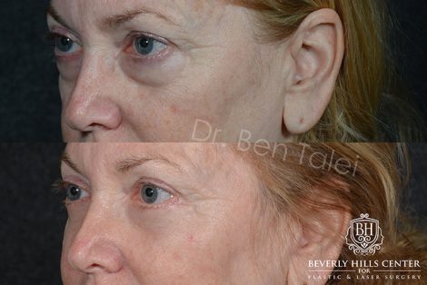 Lower Eyelid Rejuvenation - Left Side