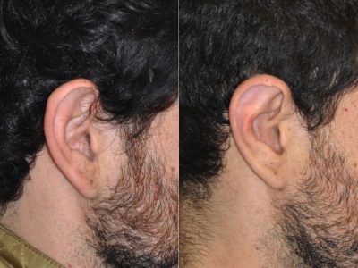 Otoplasty (Ear Pinning and Reshaping)