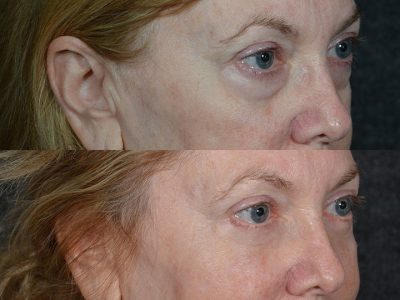 Lower Eyelid Rejuvenation - Right Side