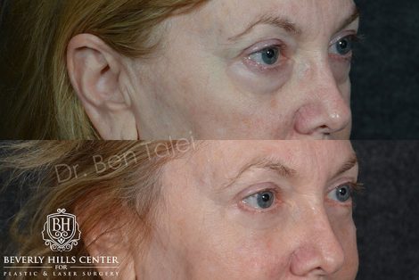 Lower Eyelid Rejuvenation - Right Side