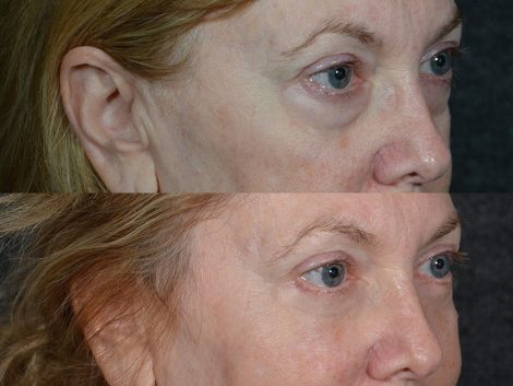 Lower Eyelid Rejuvenation - Right Side