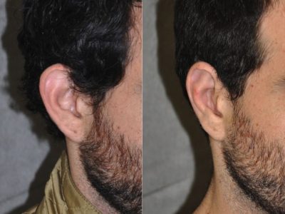 Otoplasty (Ear Pinning and Reshaping)