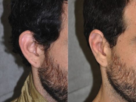 Otoplasty (Ear Pinning and Reshaping)