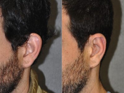 Otoplasty (Ear Pinning and Reshaping)