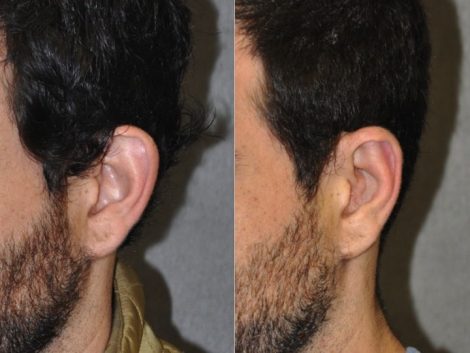 Otoplasty (Ear Pinning and Reshaping)
