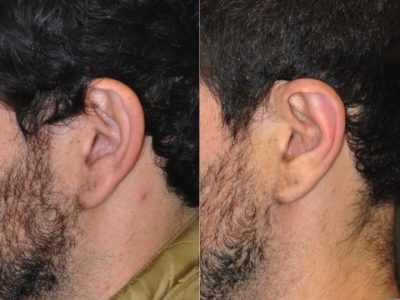 Otoplasty (Ear Pinning and Reshaping)