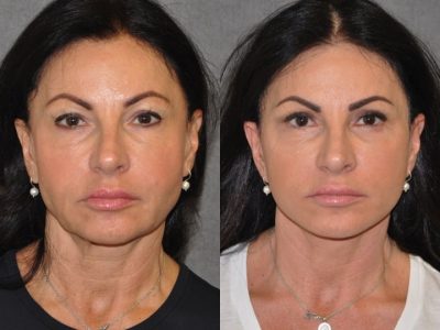 AuraLyft & Eyelid Rejuvenation - Front