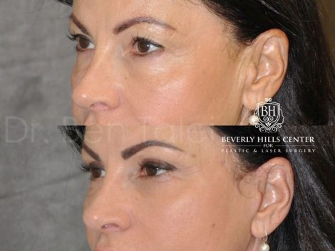 AuraLyft & Eyelid Rejuvenation - Left Side