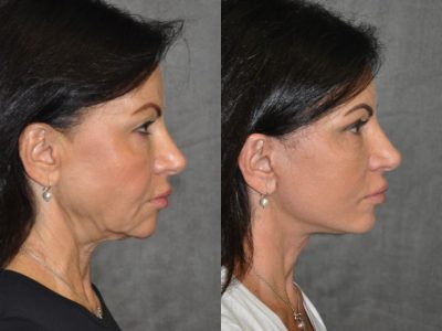 AuraLyft & Eyelid Rejuvenation - Rigth Side