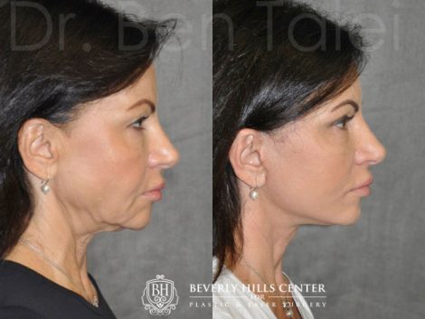 AuraLyft & Eyelid Rejuvenation - Rigth Side