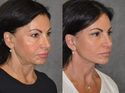 AuraLyft & Eyelid Rejuvenation - Rigth Side