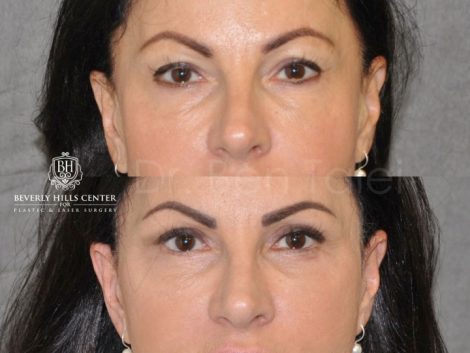 AuraLyft & Eyelid Rejuvenation - Front