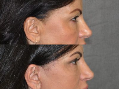AuraLyft & Eyelid Rejuvenation - Right Side