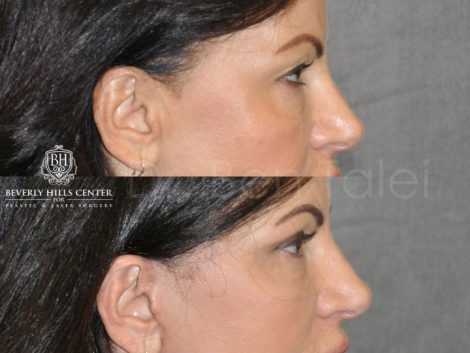 AuraLyft & Eyelid Rejuvenation - Right Side