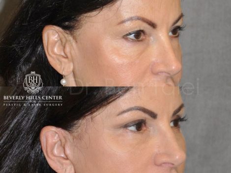 AuraLyft & Eyelid Rejuvenation - Right Side