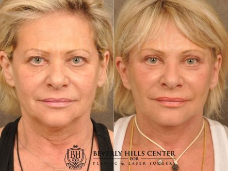 AuraLyft, Browlift, Upper & Lower Eyelid Rejuvenation