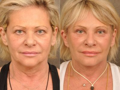 AuraLyft, Browlift, Upper & Lower Eyelid Rejuvenation