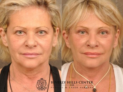 AuraLyft, Browlift, Upper & Lower Eyelid Rejuvenation