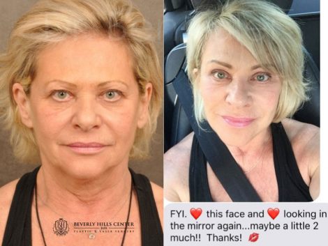 AuraLyft, Browlift, Upper & Lower Eyelid Rejuvenation