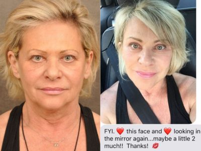 AuraLyft, Browlift, Upper & Lower Eyelid Rejuvenation