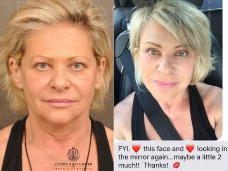 AuraLyft, Browlift, Upper & Lower Eyelid Rejuvenation