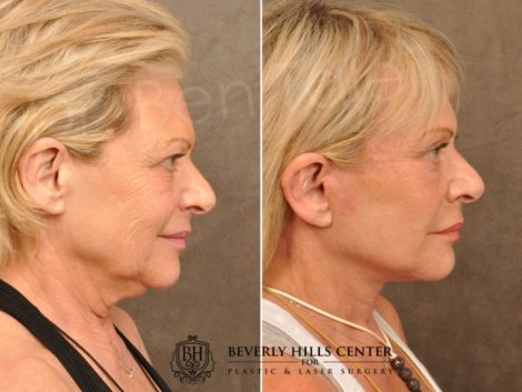 AuraLyft, Browlift, Upper & Lower Eyelid Rejuvenation