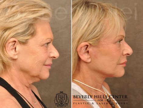 AuraLyft, Browlift, Upper & Lower Eyelid Rejuvenation