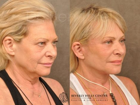 AuraLyft, Browlift, Upper & Lower Eyelid Rejuvenation