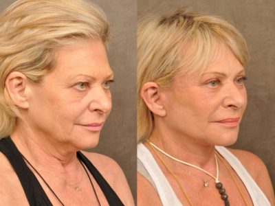 AuraLyft, Browlift, Upper & Lower Eyelid Rejuvenation