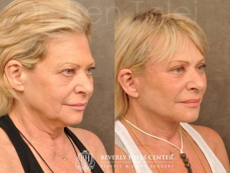 AuraLyft, Browlift, Upper & Lower Eyelid Rejuvenation