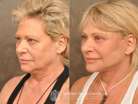 AuraLyft, Browlift, Upper & Lower Eyelid Rejuvenation