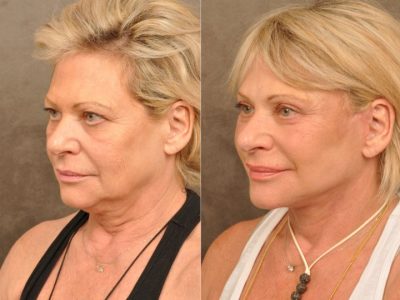 AuraLyft, Browlift, Upper & Lower Eyelid Rejuvenation