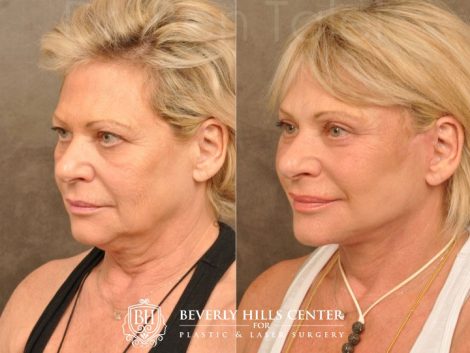 AuraLyft, Browlift, Upper & Lower Eyelid Rejuvenation